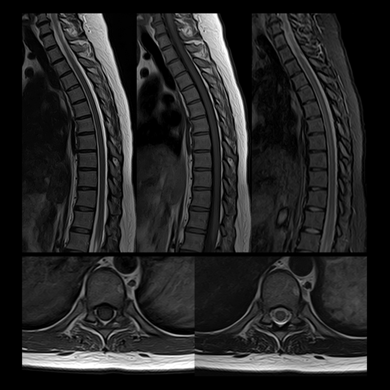 Vantage Elan Spine