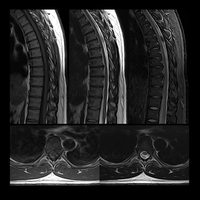 Vantage Elan Spine
