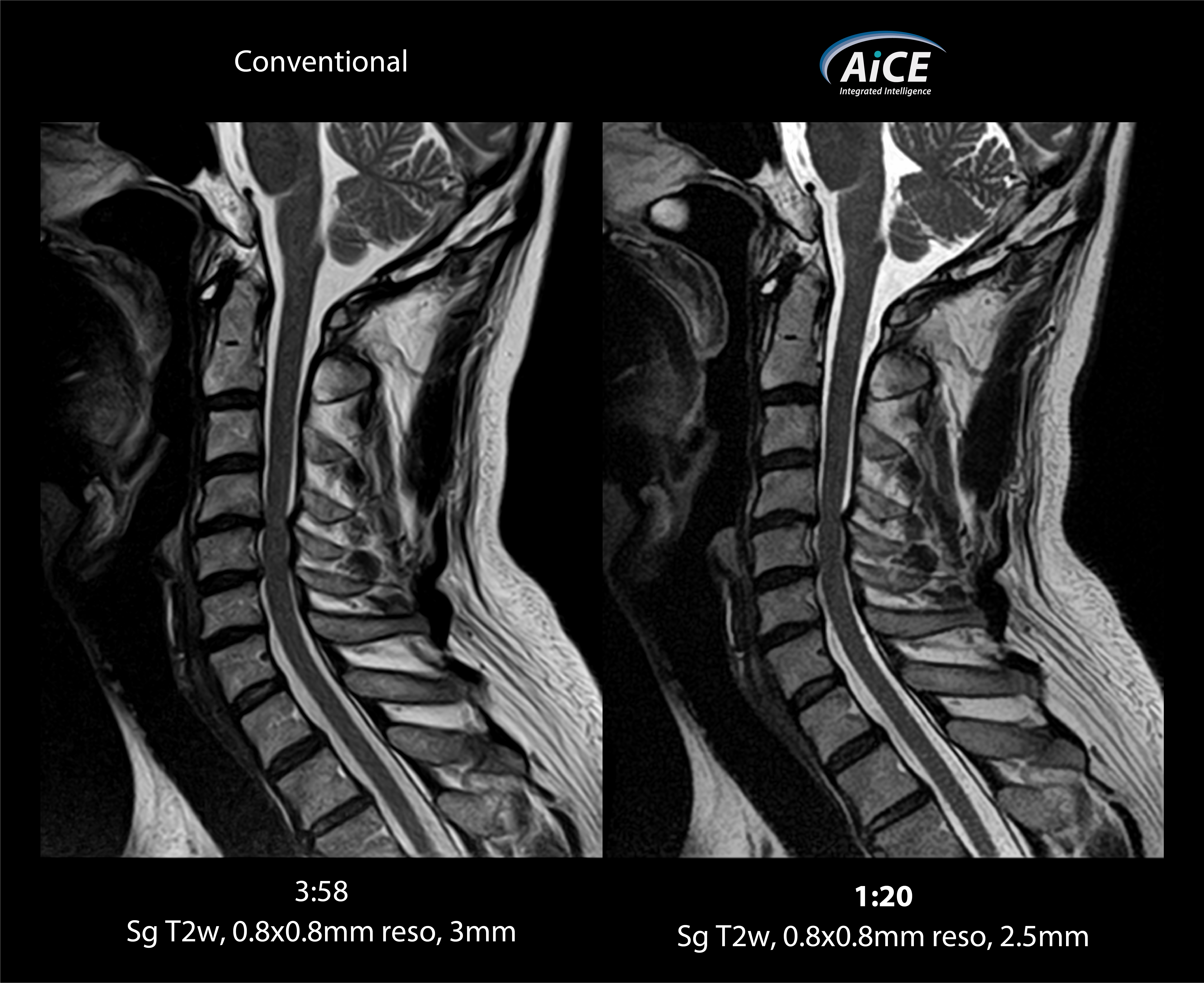 Vantage Elan C-spine 1