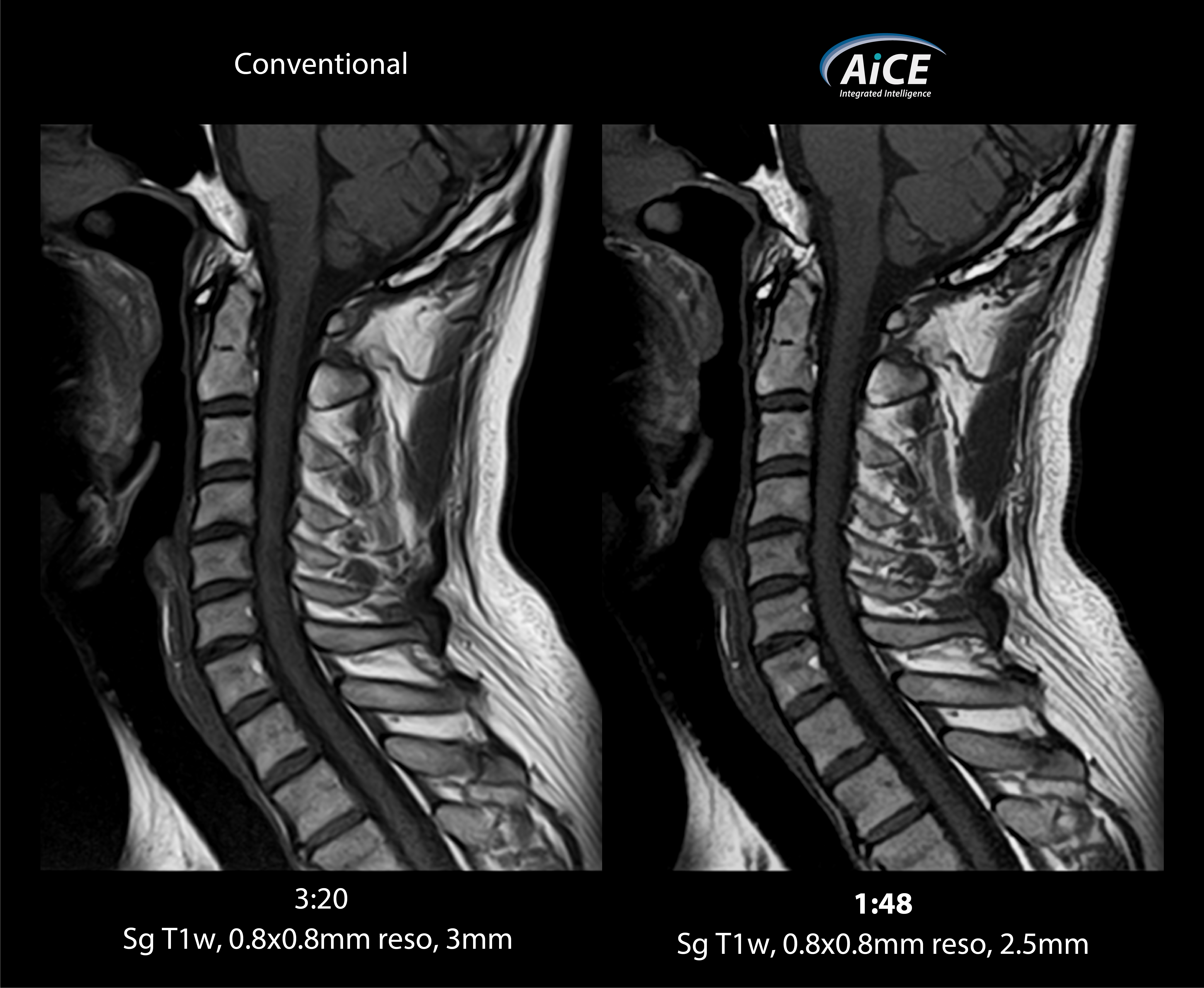 Vantage Elan C-spine 1