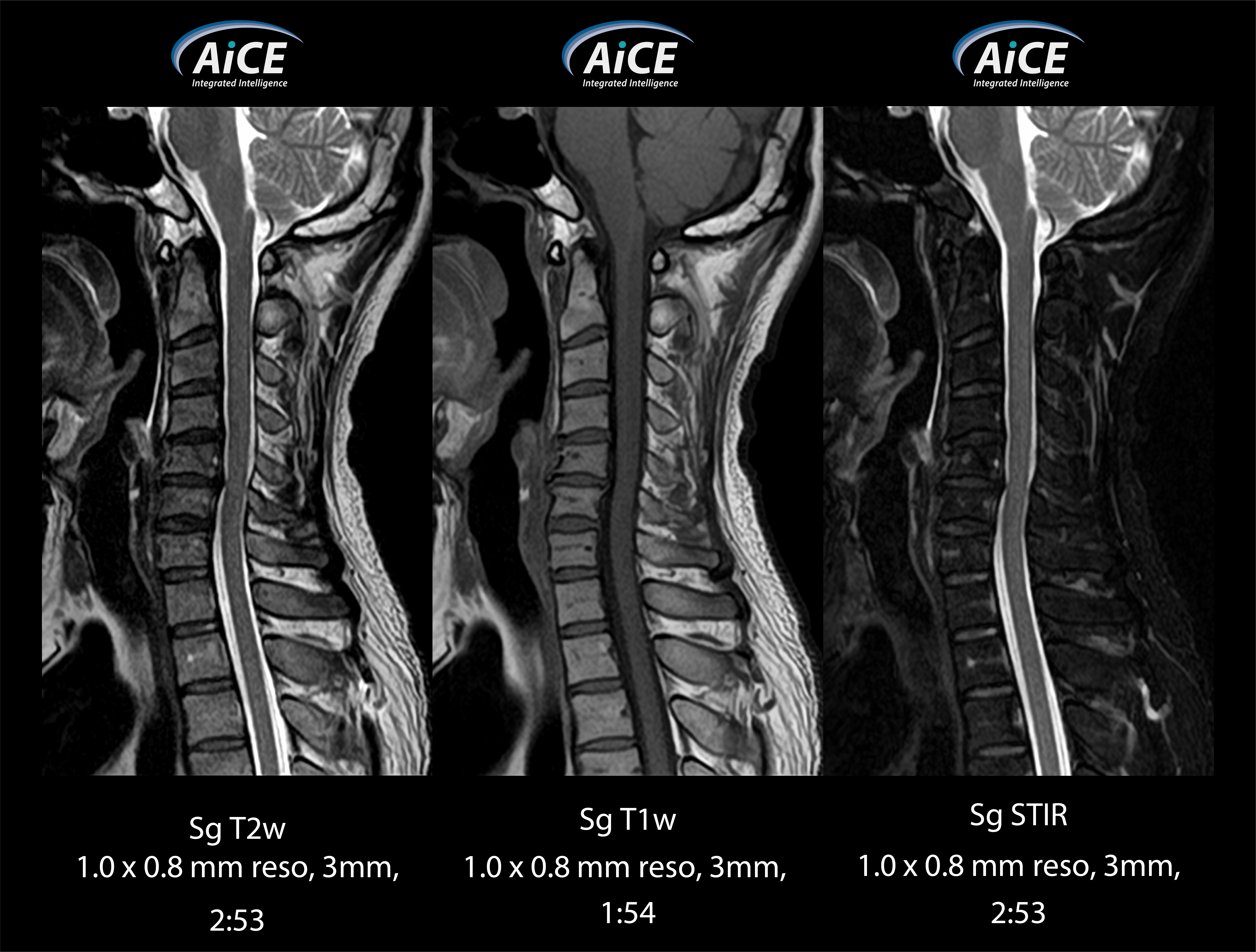 Vantage Elan C-spine 2