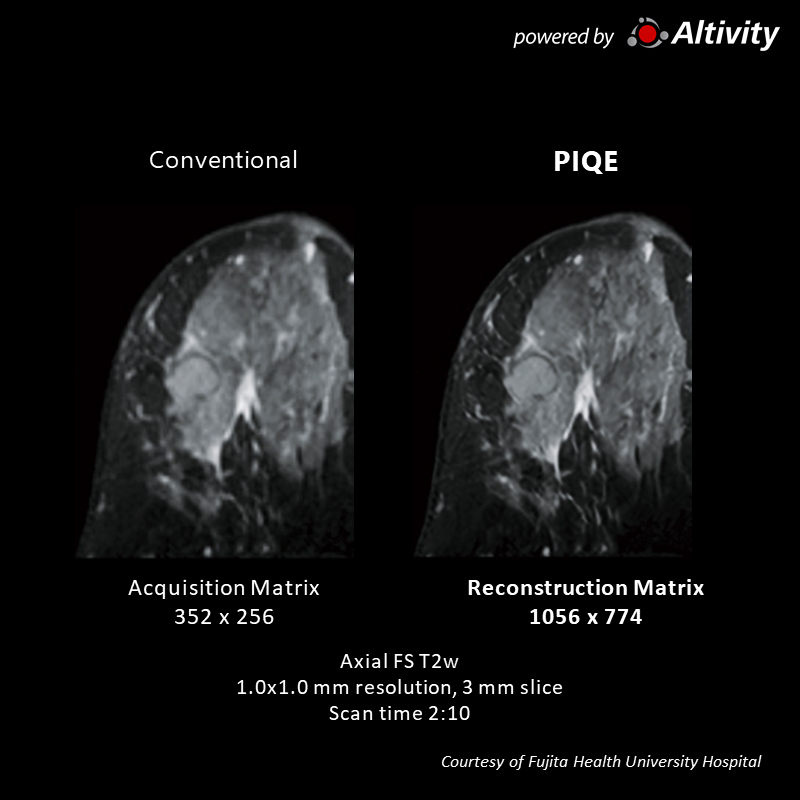 Vantage Galan 3T Supreme Edition Right CD area breast tumor