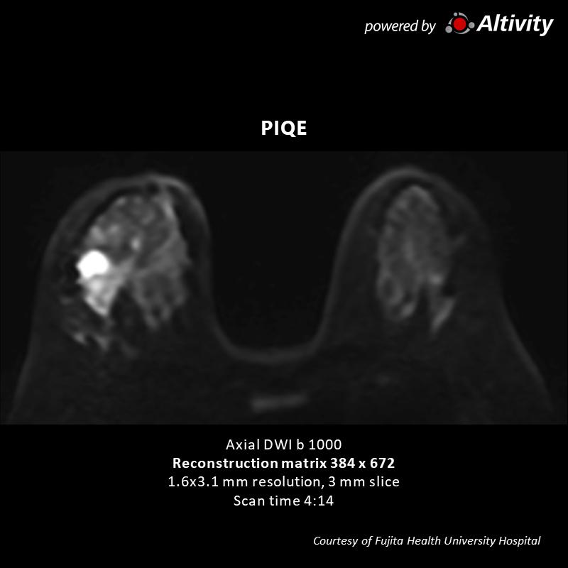 Vantage Galan 3T Supreme Edition Right CD area breast tumor