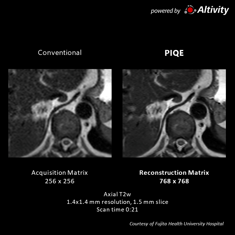 Vantage Galan 3T Supreme Edition multiple hepatic hyper-vascularized tumors