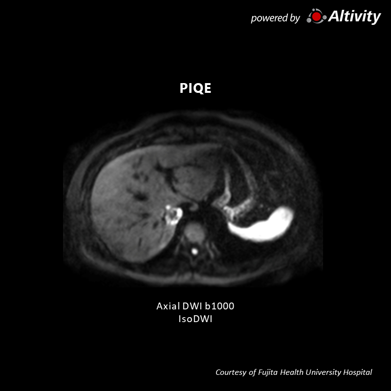 Vantage Galan 3T Supreme Edition multiple hepatic hyper-vascularized tumors