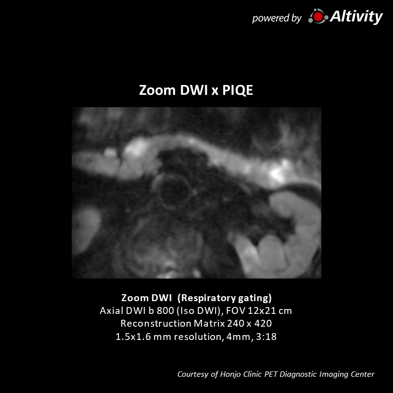 Vantage Galan 3T Supreme Edition Pancreatic tumor