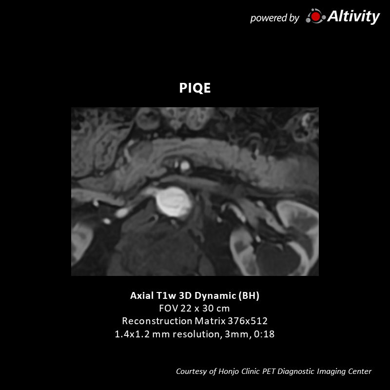 Vantage Galan 3T Supreme Edition Pancreatic tumor