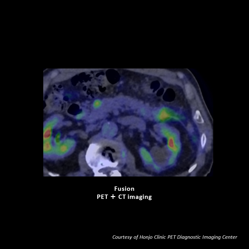 Vantage Galan 3T Supreme Edition Pancreatic tumor