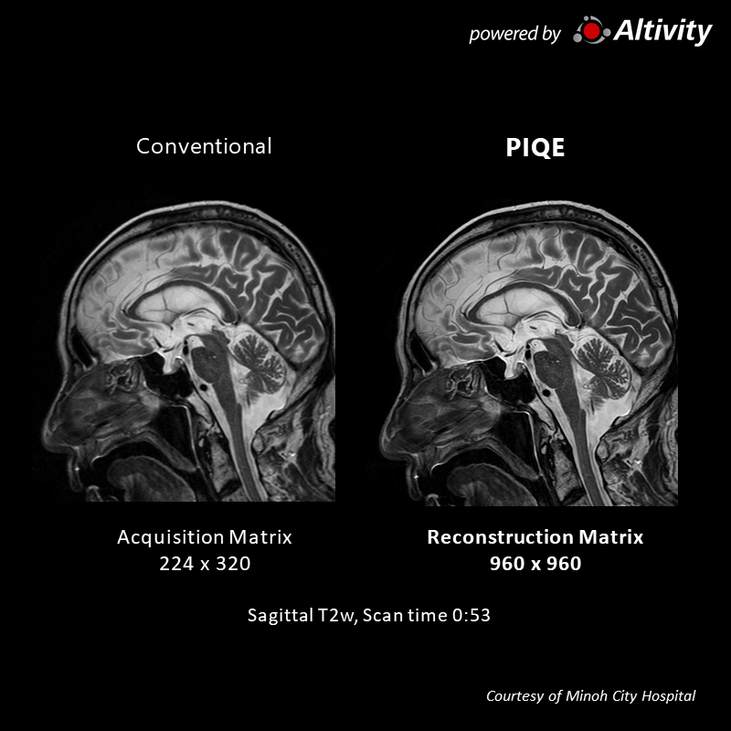 Vantage Galan 3T Supreme Edition Postoperative lung cancer cranial metastasis
