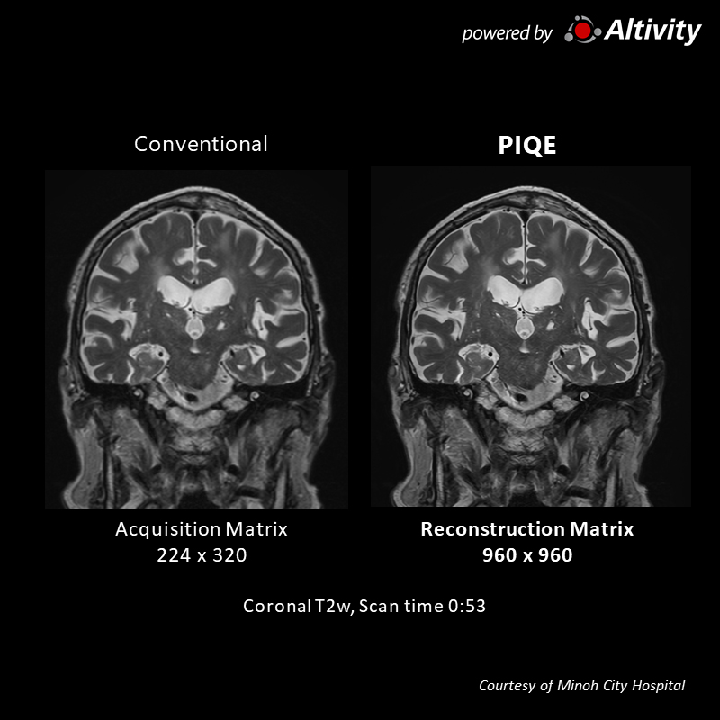 Vantage Galan 3T Supreme Edition Postoperative lung cancer cranial metastasis