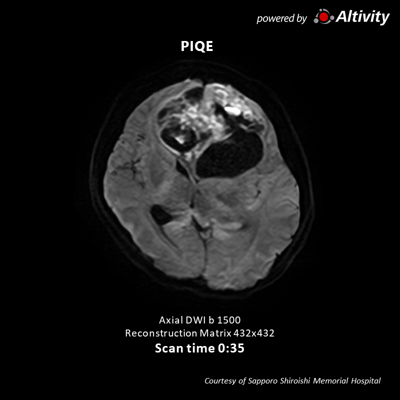 Vantage Galan 3T Supreme Edition Brain tumor