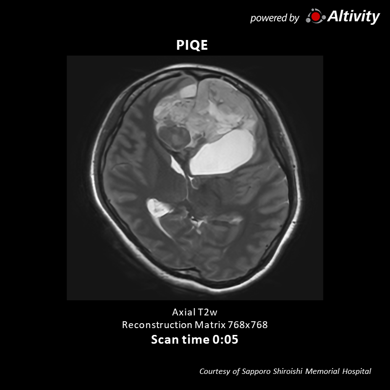 Vantage Galan 3T Supreme Edition Brain tumor