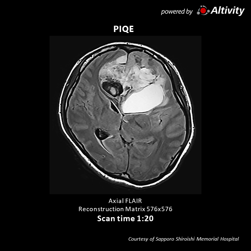 Vantage Galan 3T Supreme Edition Brain tumor