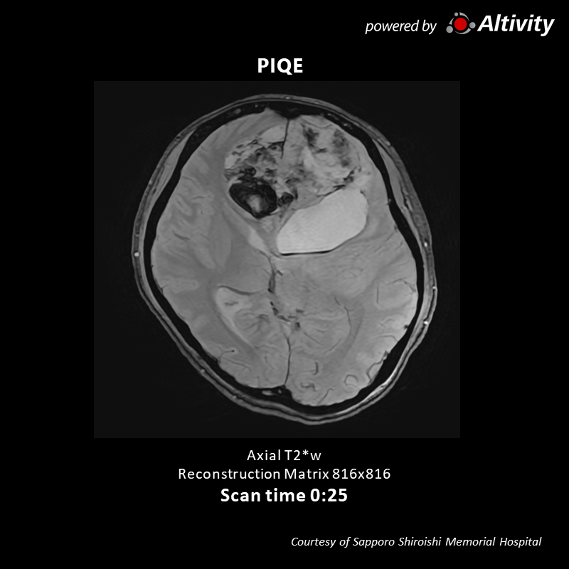 Vantage Galan 3T Supreme Edition Brain tumor