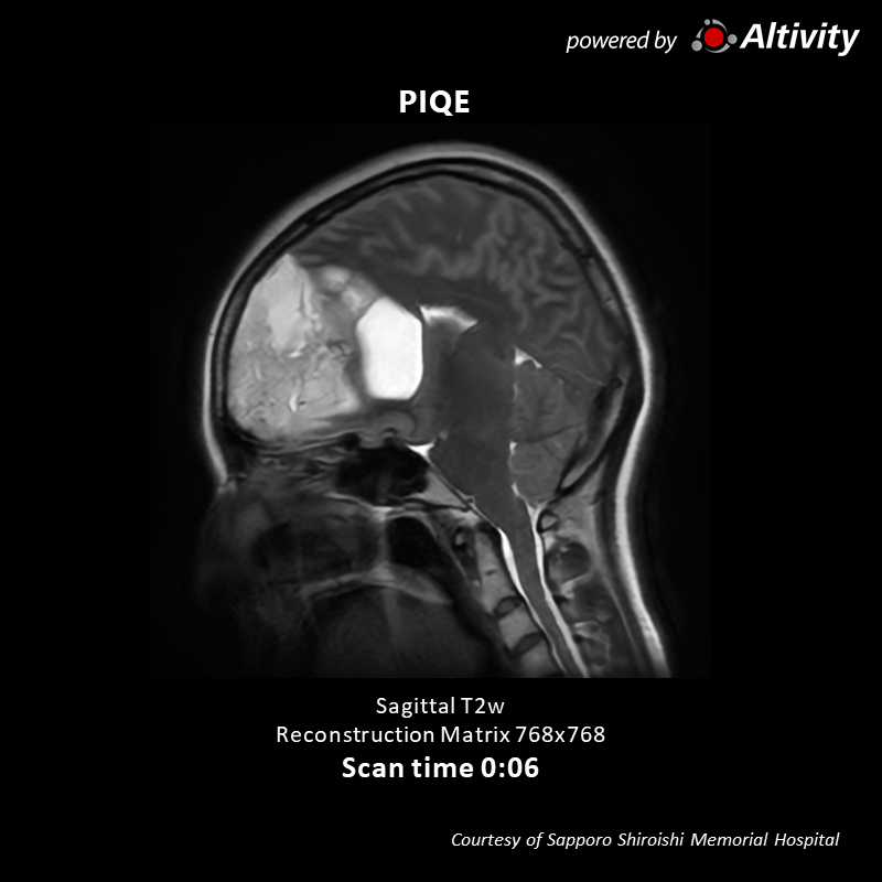 Vantage Galan 3T Supreme Edition Brain tumor