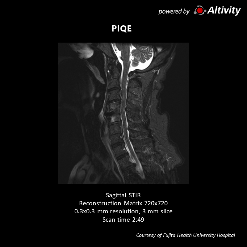 Vantage Galan 3T Supreme Edition Postoperative spinal stenosis
