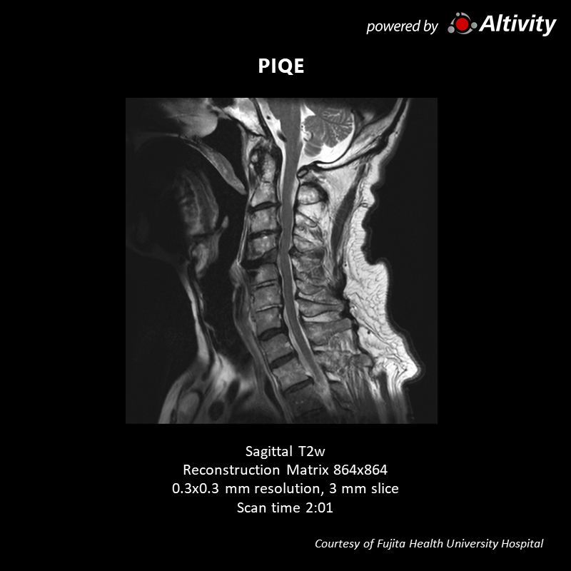 Vantage Galan 3T Supreme Edition Postoperative spinal stenosis
