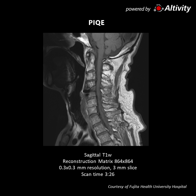 Vantage Galan 3T Supreme Edition Postoperative spinal stenosis