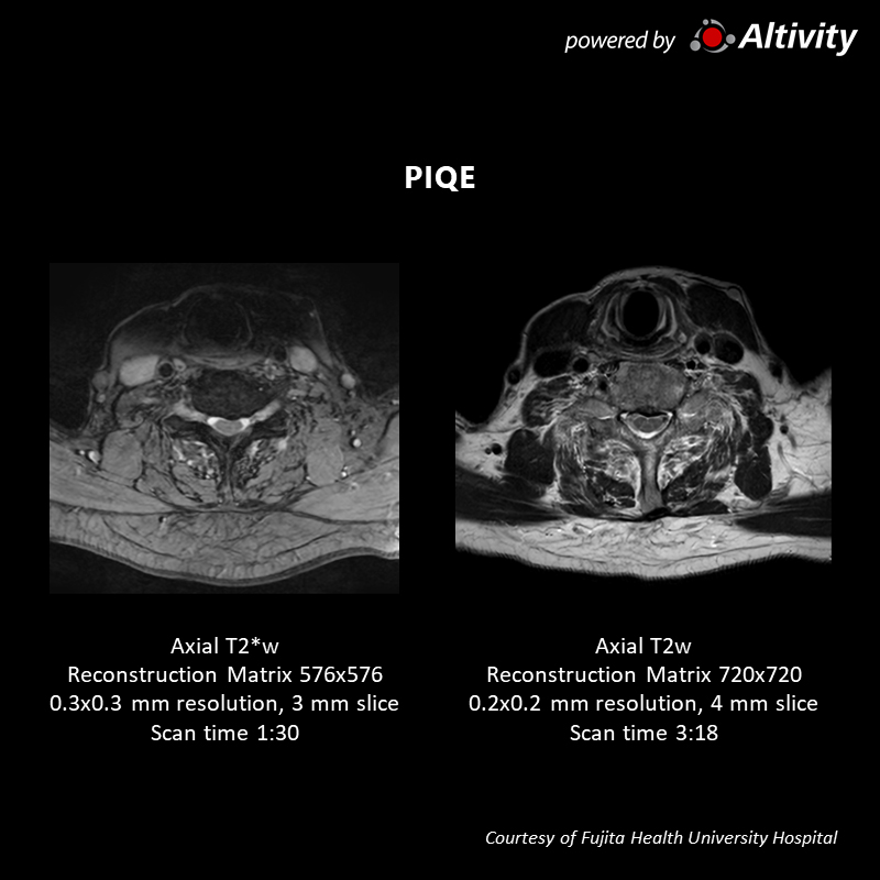 Vantage Galan 3T Supreme Edition Postoperative spinal stenosis