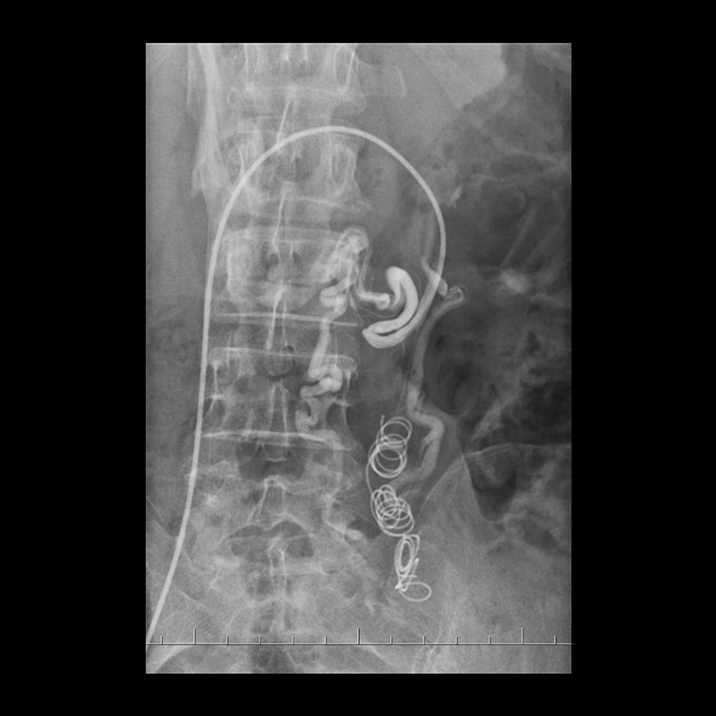 Ultimax-i Venous Embolization