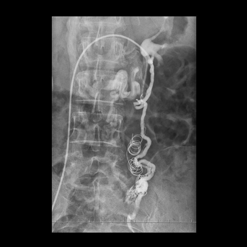 Ultimax-i Venous Embolization