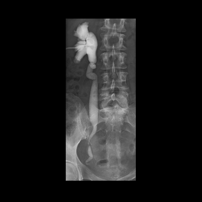 Ultimax-i Nephro Venogram
